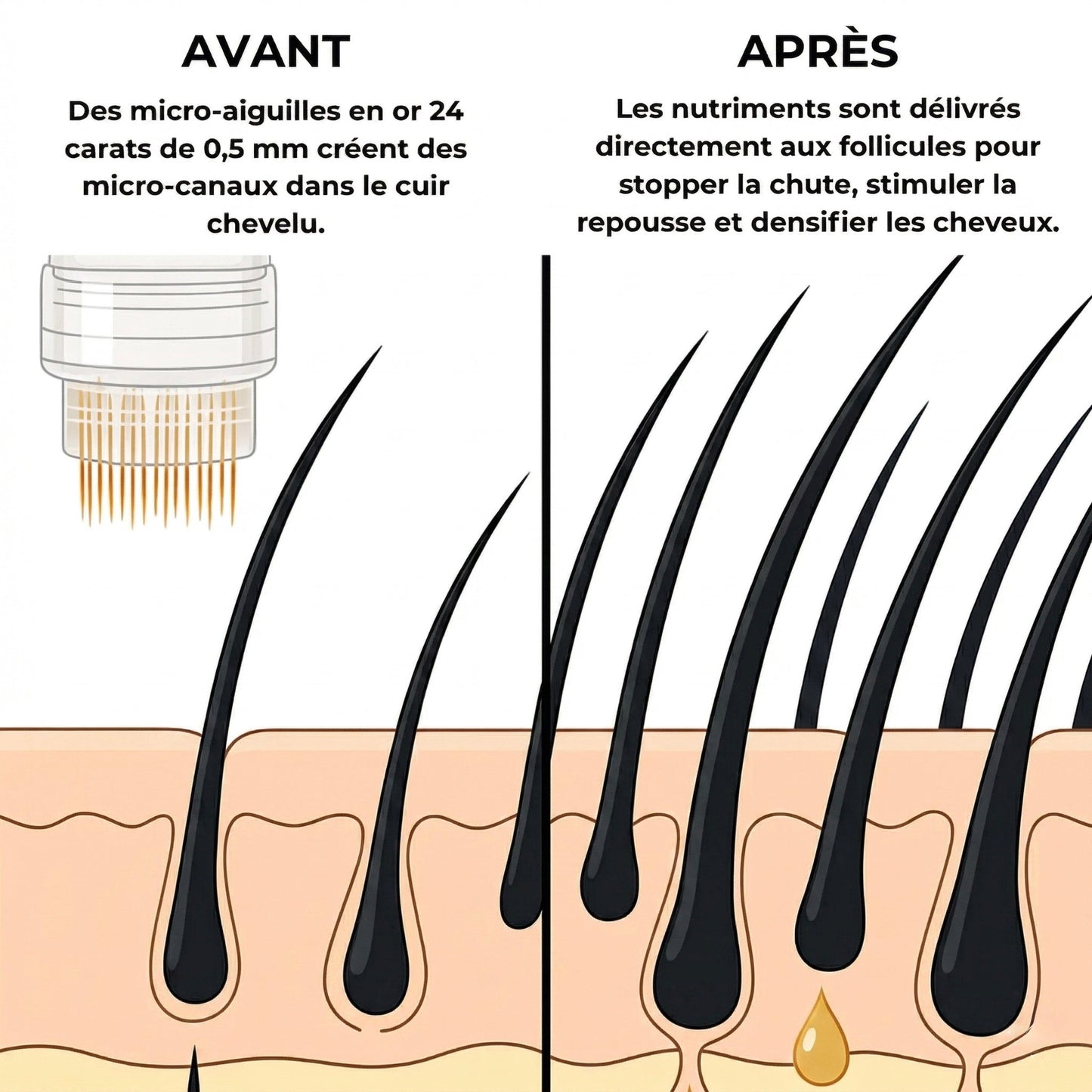 InfuseX® by Capilys – Traitement chute de cheveux héréditaire - Capilys