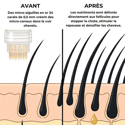InfuseX® by Capilys – Traitement chute de cheveux héréditaire - Capilys