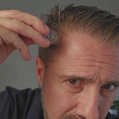 InfuseX® by Capilys – Traitement chute de cheveux héréditaire homme