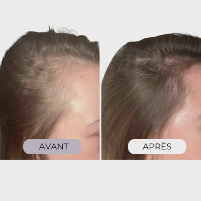 InfuseX® by Capilys – Traitement chute de cheveux femme