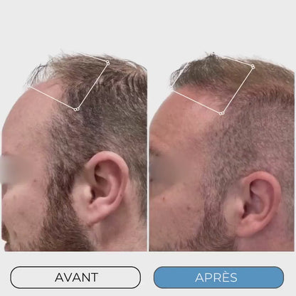 InfuseX® by Capilys – Traitement chute de cheveux héréditaire homme